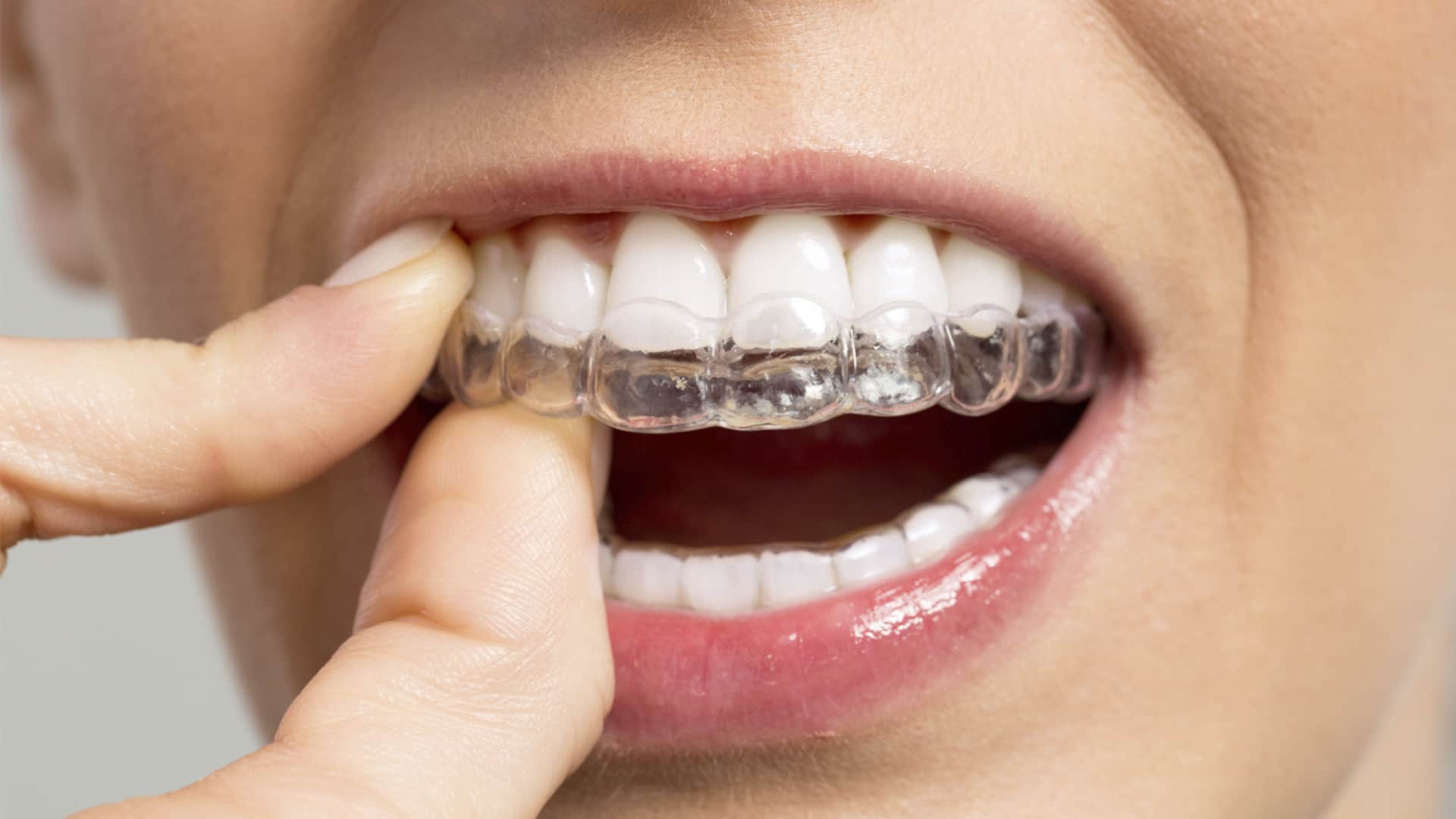 Ortodoncia Invisalign en Cartaya (Huelva) - Clínica Dental María Gómez Palacios