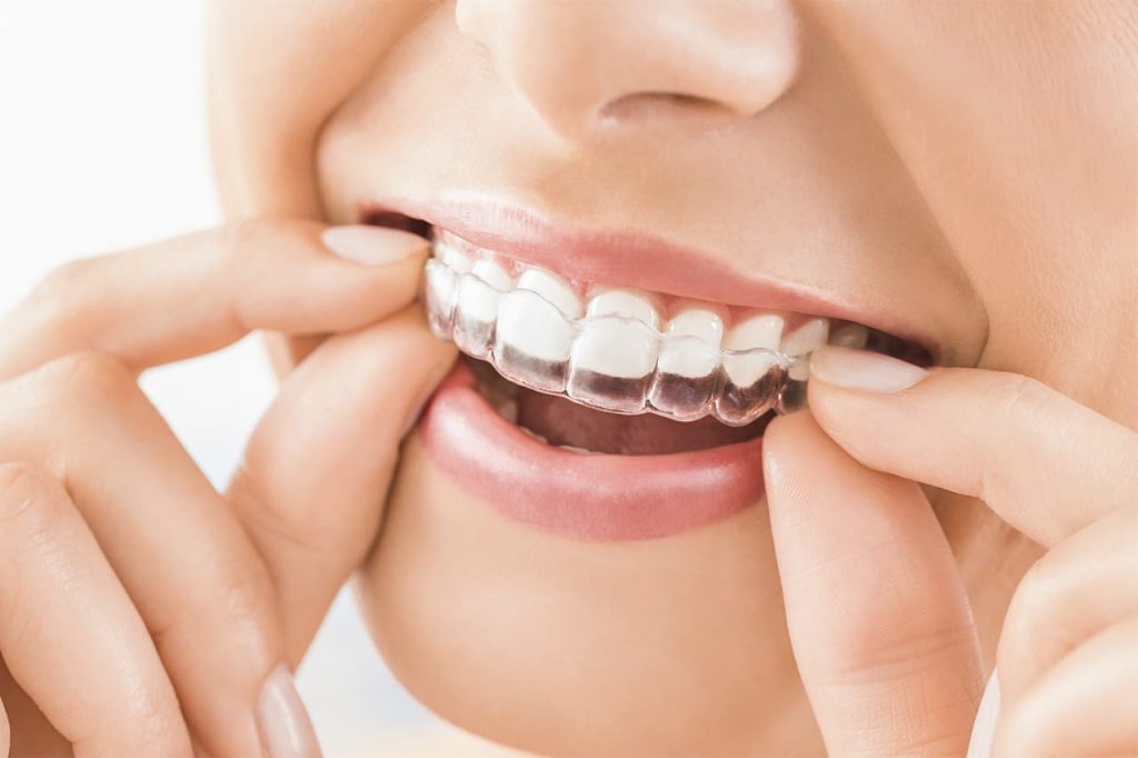 ortodoncia invisible invisalign dentistas cartaya huelva