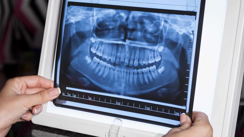 PANOREX - Radiografía Panorámica - Ortopantomografía en Cartaya (Huelva) - Clínica Dental María Gómez Palacios